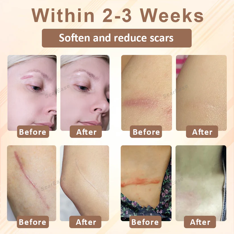 Soothe and regenerate damaged skin with ScarEase™ SiliconeFoam Healing Pads, designed for sensitive skin.