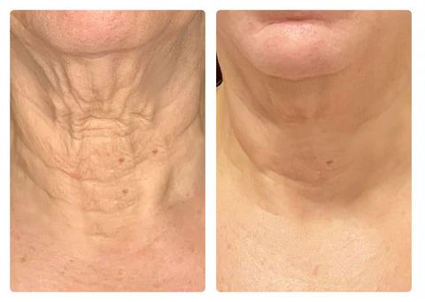 Improve skin elasticity and smoothness with TightenLift™ SkinRenewal FirmingOil.