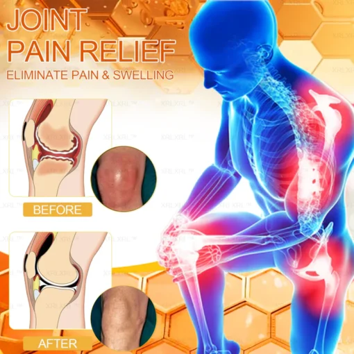 XRLXRL™ Bee Venom Arthritis Therapy Cream quickly reduces joint swelling and discomfort for immediate relief.