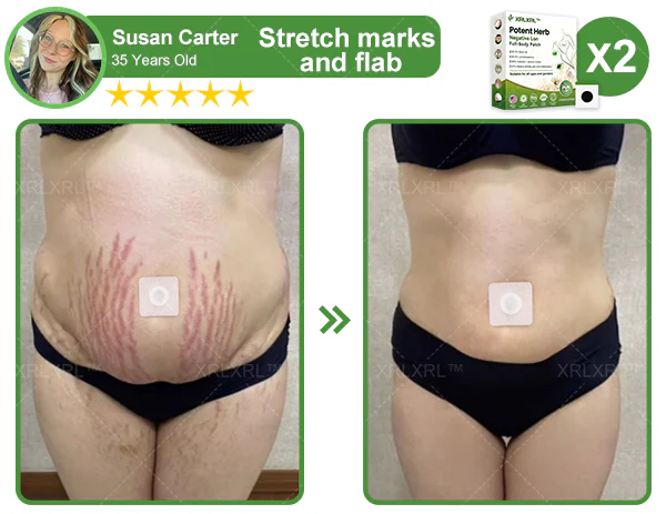 XRLXRL™ Potent Herb Negative Ion full-body Patch: A natural, effective remedy for reducing fat and improving skin tone.