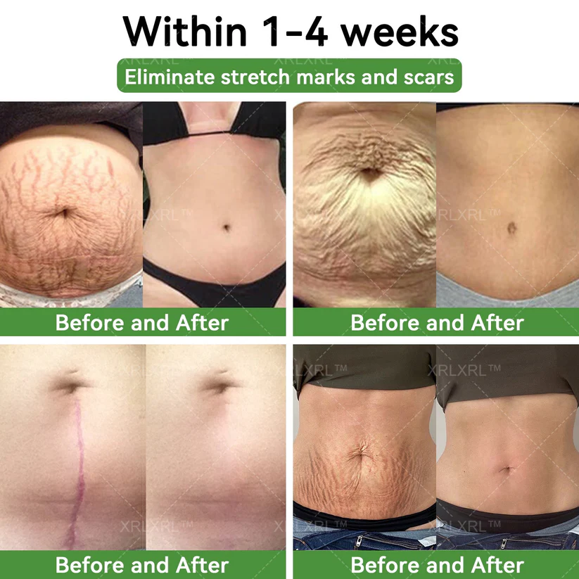 XRLXRL™ Potent HerbIon Negative Ion Detox Slimming Patches renew your skin and minimize the appearance of stretch marks.