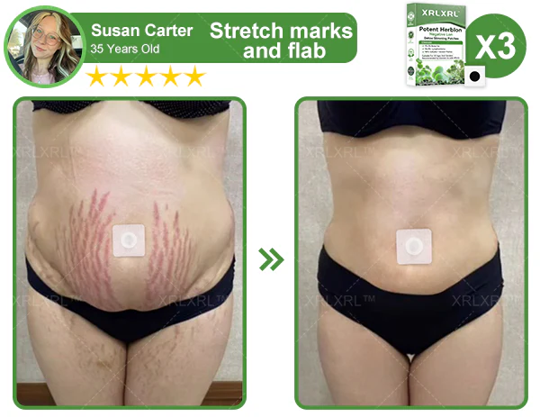 XRLXRL™ Potent HerbIon Negative Ion Detox Slimming Patches help you achieve your desired body shape in 1-4 weeks!