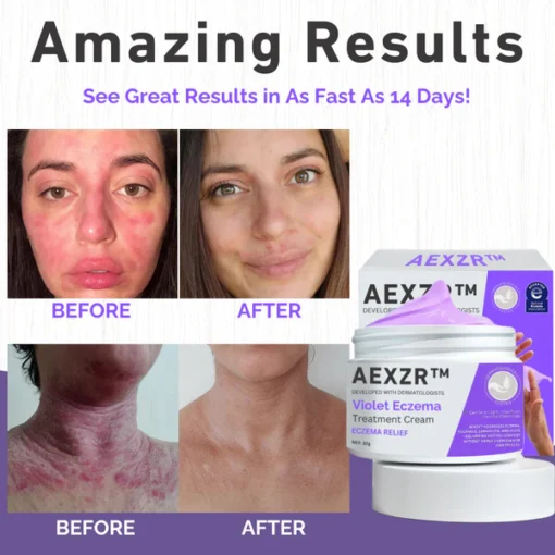 AEXZR™ Violet Eczema Treatment Cream minimizes chemical risks, providing a safe and natural alternative for skin treatment.