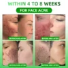 Reduce acne scars and achieve healthier skin with Toclvo™ Body Acne Serum, designed for visible results in just weeks.