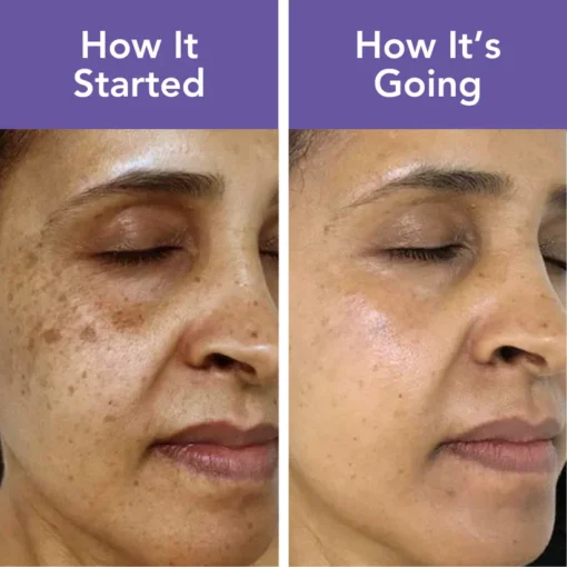 Discover brighter skin with Fivfivgo™ Age Spots Removal Patches that fade dark spots and enhance your natural glow effortlessly.