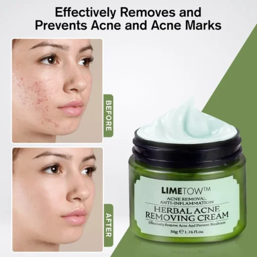 LIMETOW™ Herbal Acne Removal Cream targets acne with natural ingredients, soothing the skin and promoting a healthy appearance.