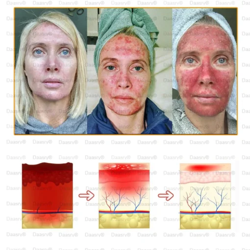 Daasry® All-Body Skin Treatment Cream soothes dry and acne-prone skin, promoting healing.