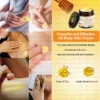 Daasry® All-Body Skin Treatment Cream reduces the appearance of acne scars and blemishes.