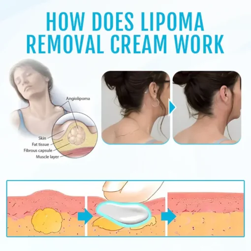 Fivfivgo™ LumpClear Lipoma Relief Cream