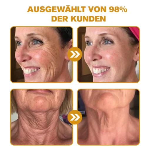 Furzero™ Botox Bienengift Faltenentfernungscreme wirkt gegen Augenringe und Tränensäcke.