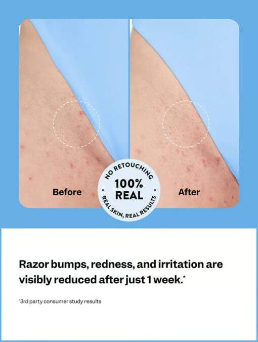 Smoothing Solution Ingrown Hair Treatment hydrates and prevents painful ingrown hairs.